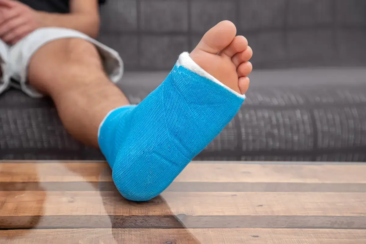 close-up-of-male-foot-in-plaster-cast-with-blue-sp-2025-04-02-20-36-11-utc