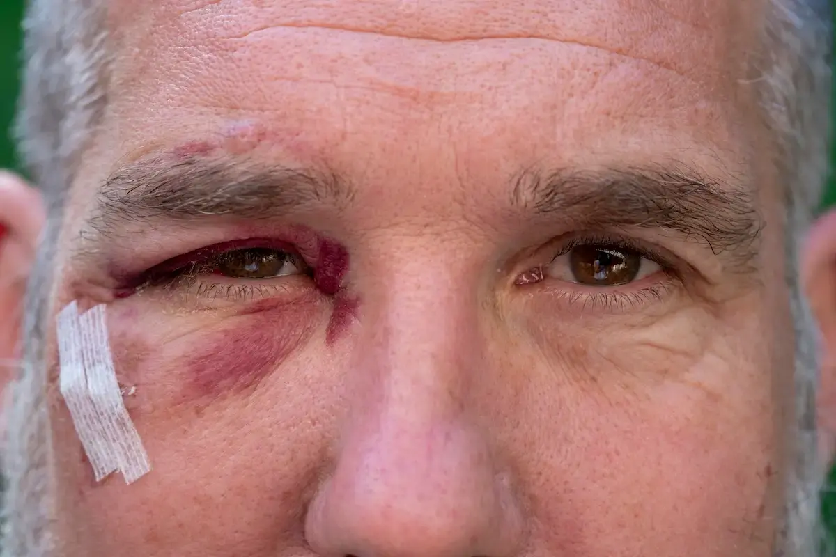 close-up-of-man-with-black-eye-2024-09-22-20-12-41-utc
