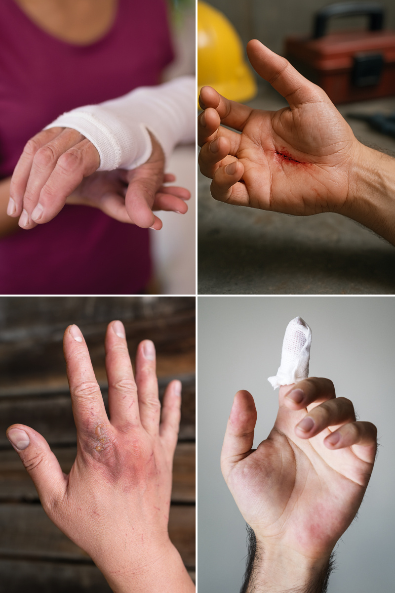 hand_injuries